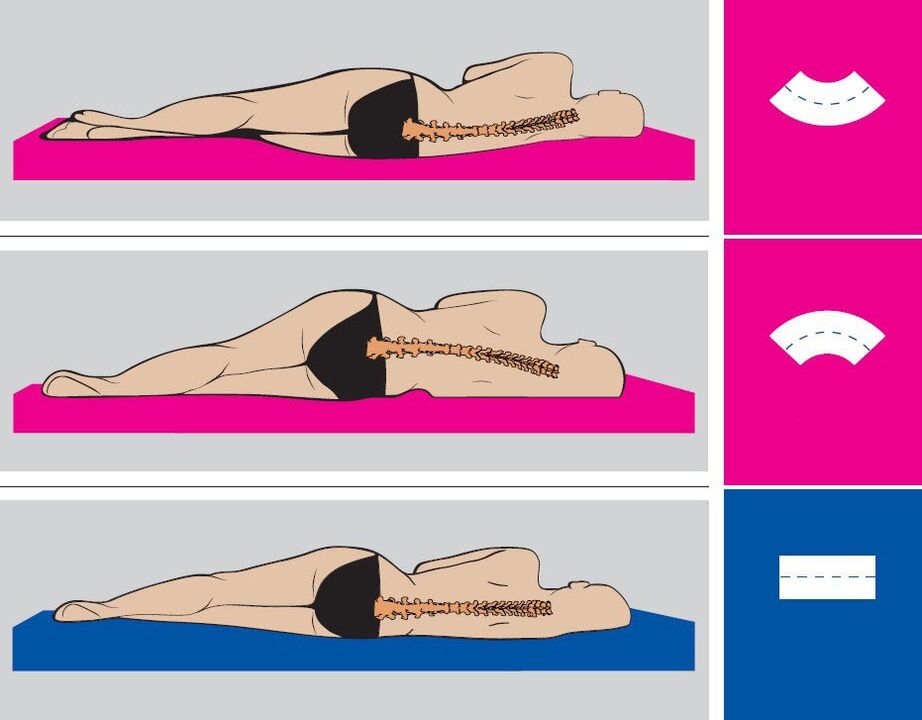 Posición corporal correcta durante o sono con osteocondrose lumbar