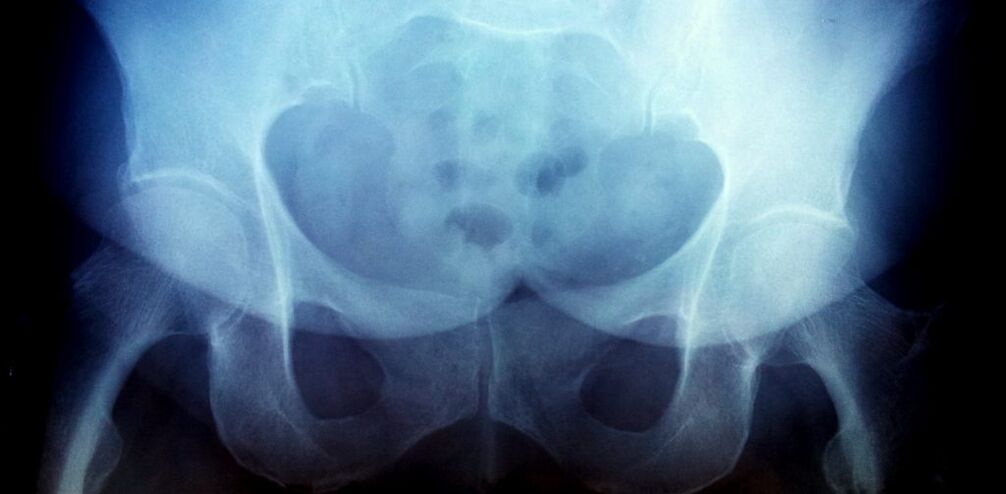Imaxe x -ray con artrose do 2º grao